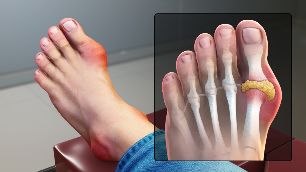 Graphic of a foot showing gout.